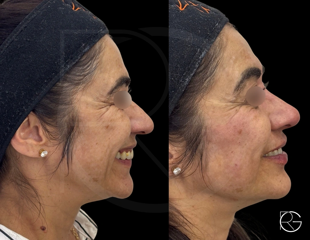 Harmonização facial com ácido hialurônico