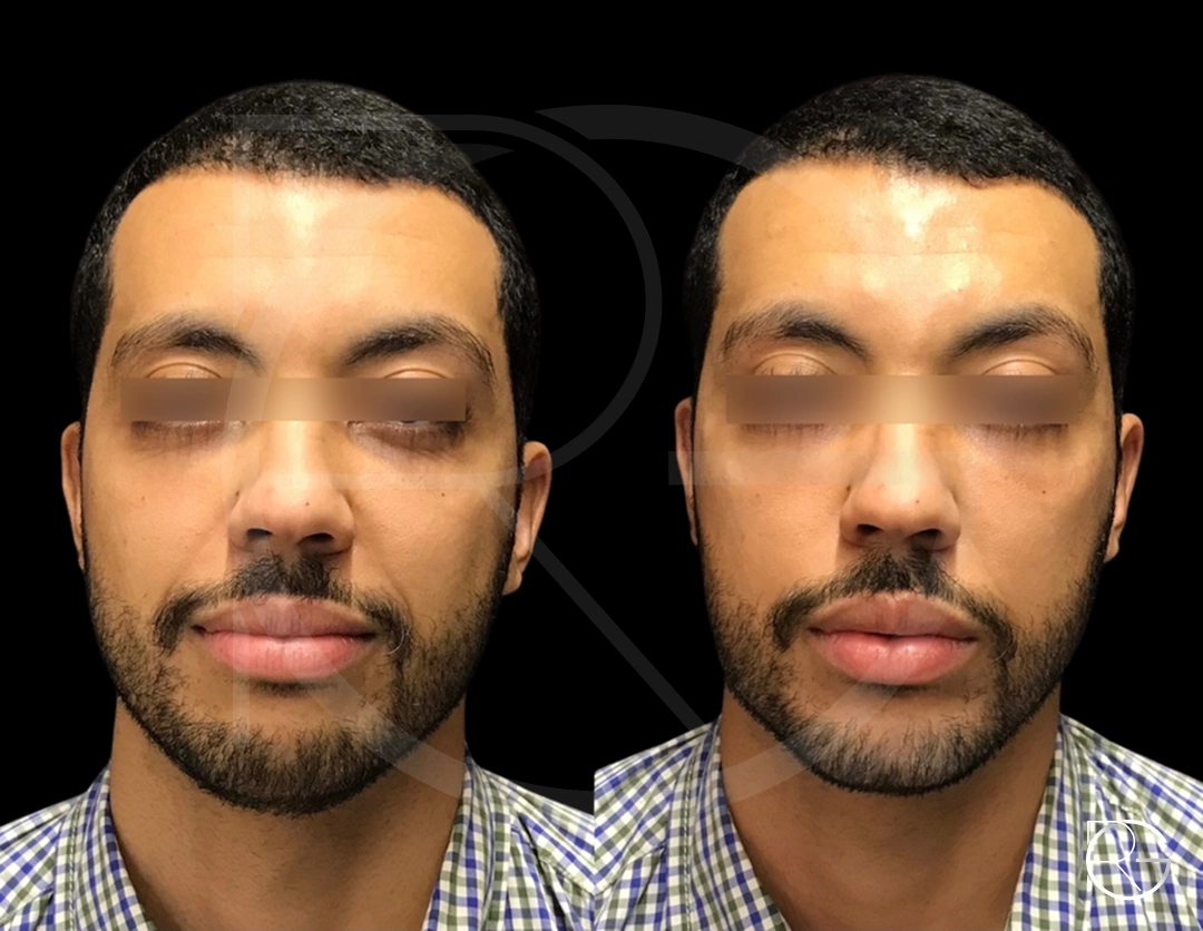 Harmonização facial masculina