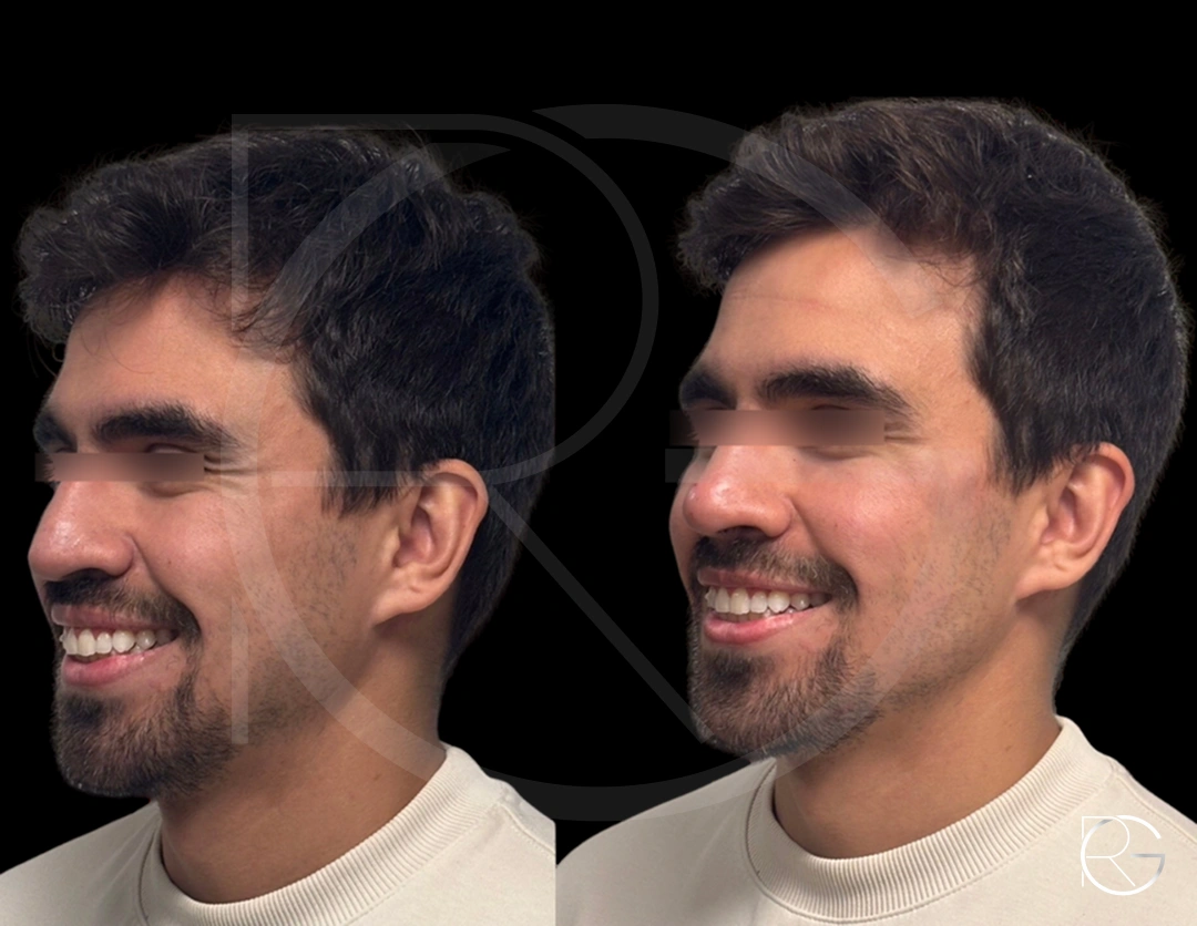 Harmonização facial masculina