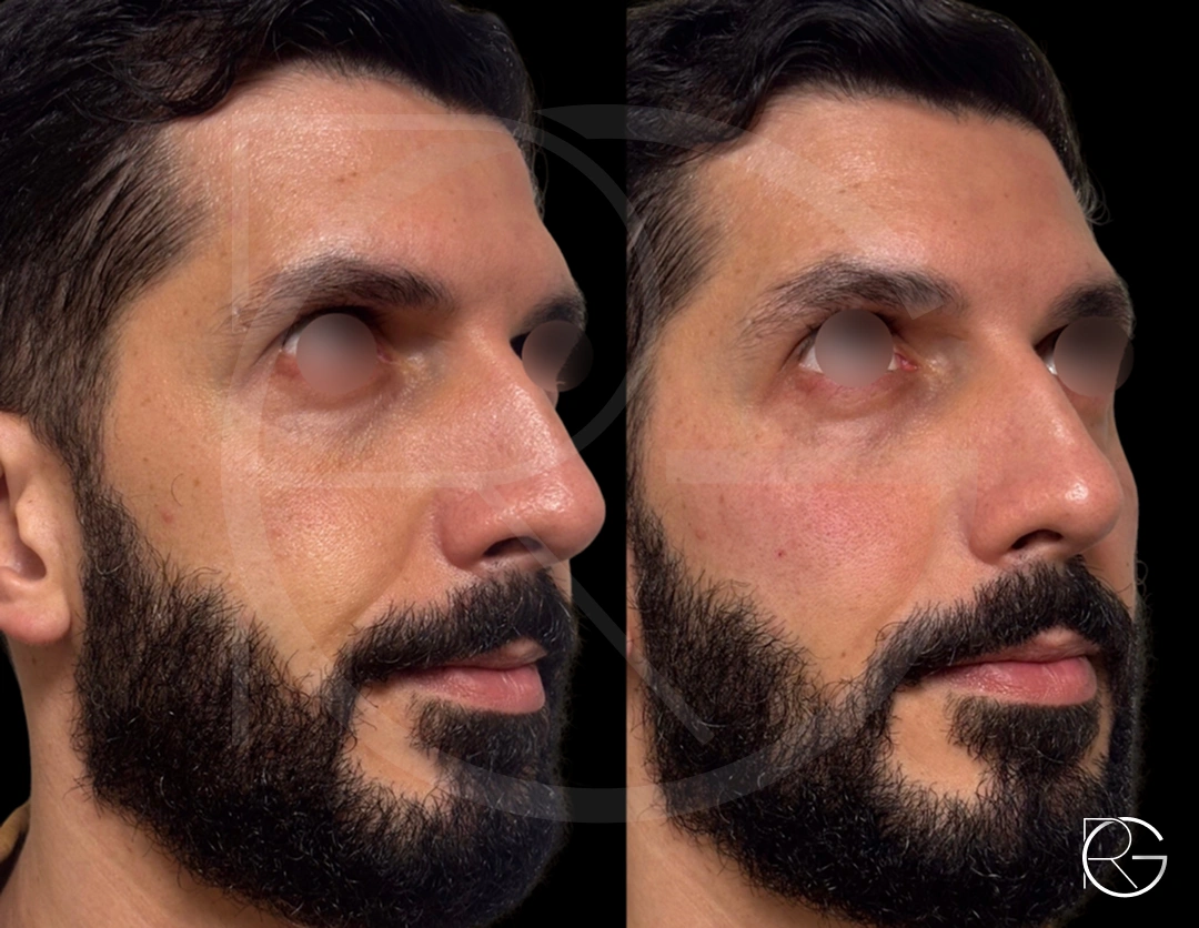 Ultraformer MPT + Bioestimulsdor de e colágeno + preenchimento de sustentação