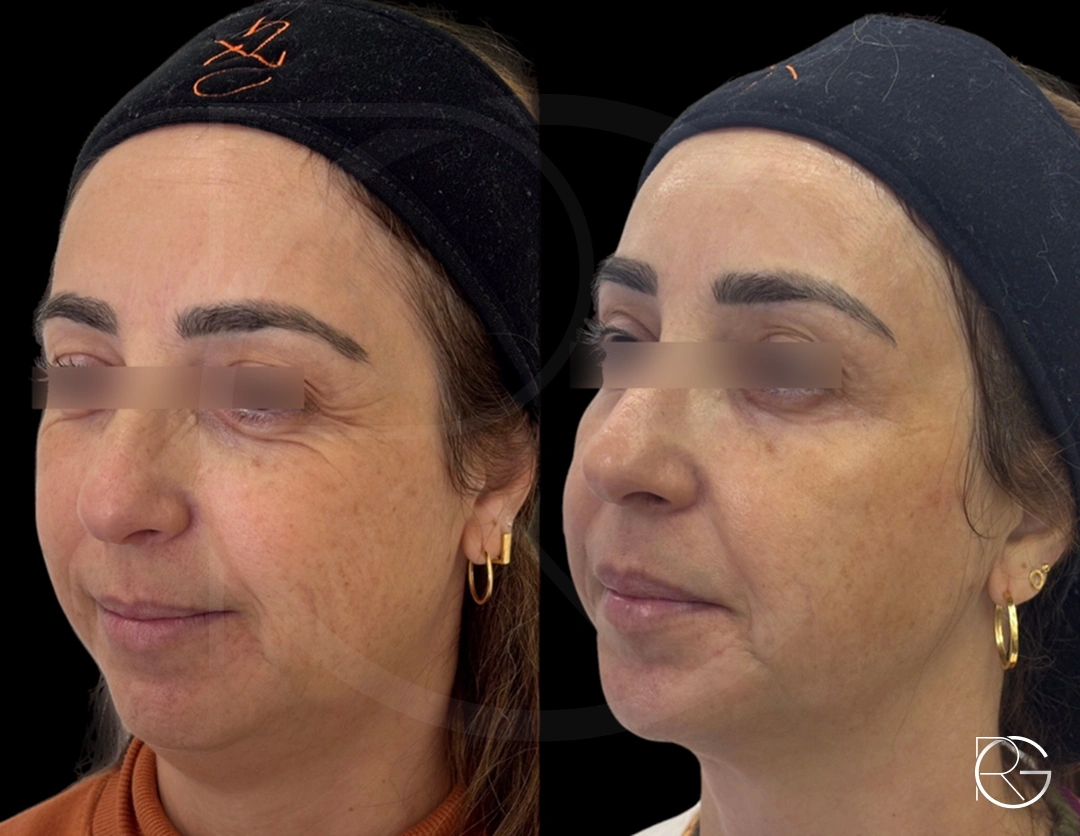 Ultraformer + toxina botulínica + peeling químico