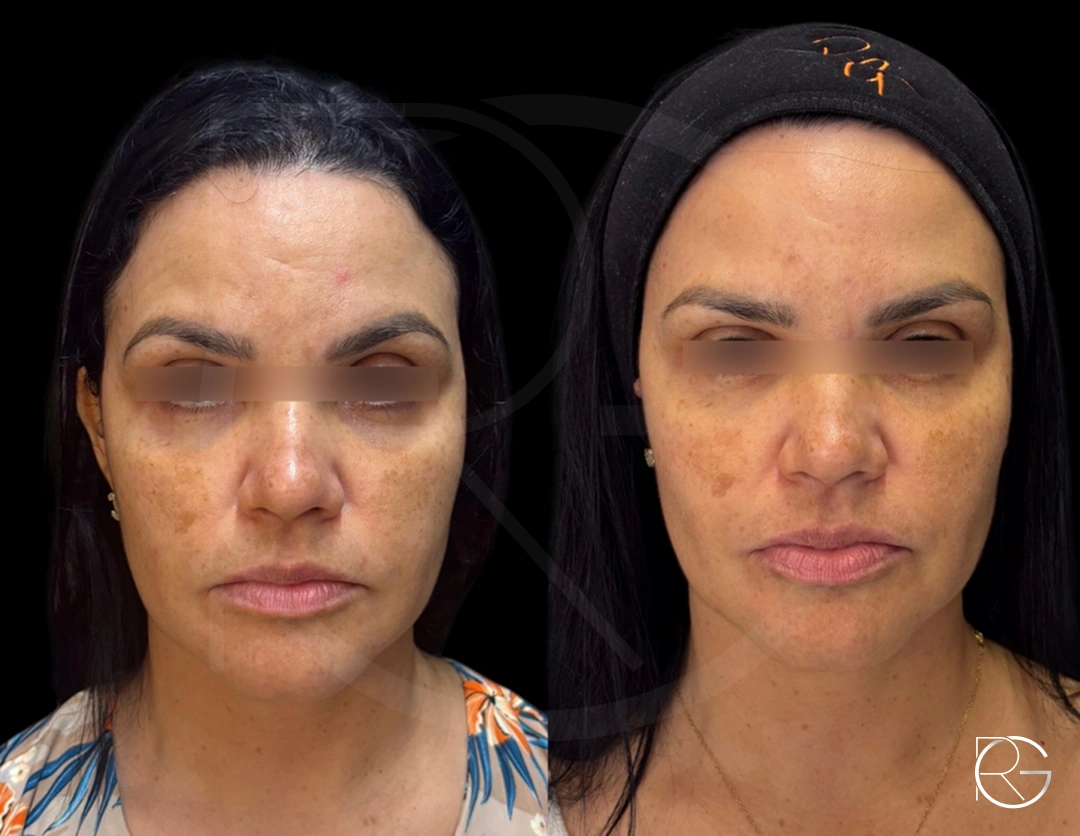 Ultraformer + toxina botulínica